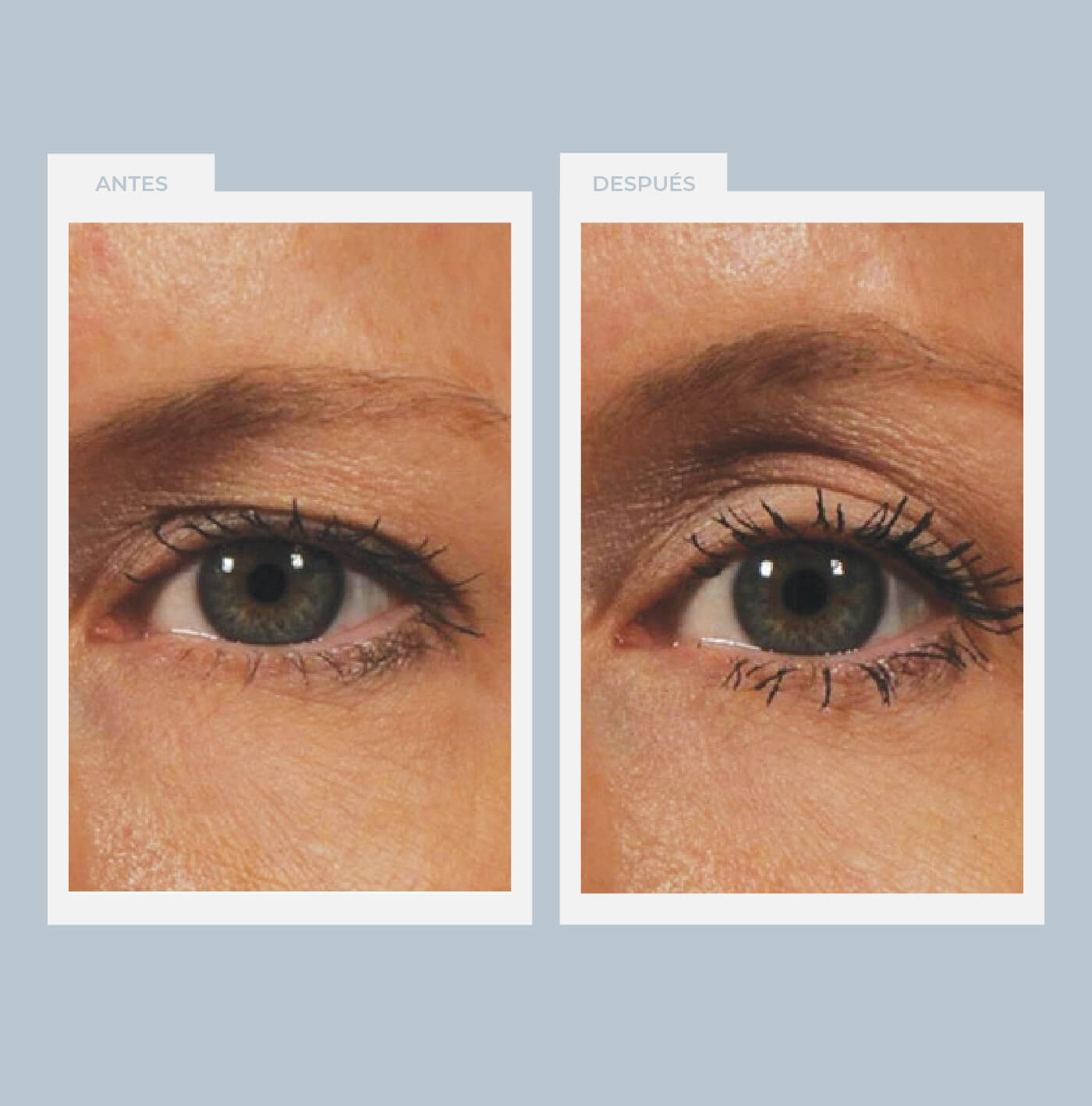 Ultherapy para zona periocular